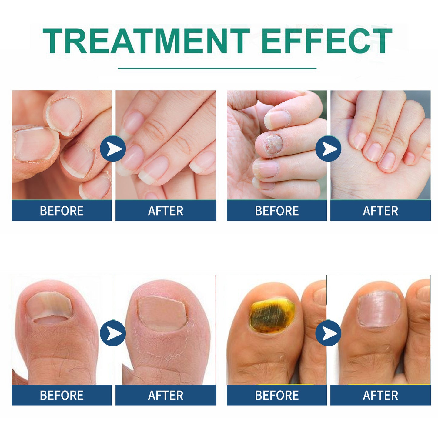 FungalCure™ - Renewal Fungal Nail Patches
